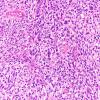 1B5 Primary Intracranial Sarcoma, Dicer 1 Mutant (Case 1) H&E 20X 3