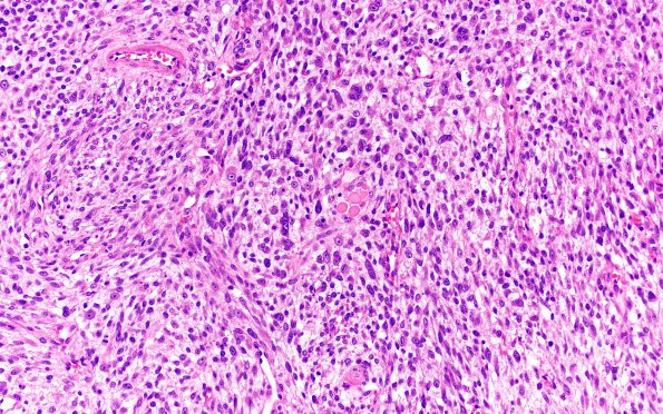 1B5 Primary Intracranial Sarcoma, Dicer 1 Mutant (Case 1) H&E 20X 3