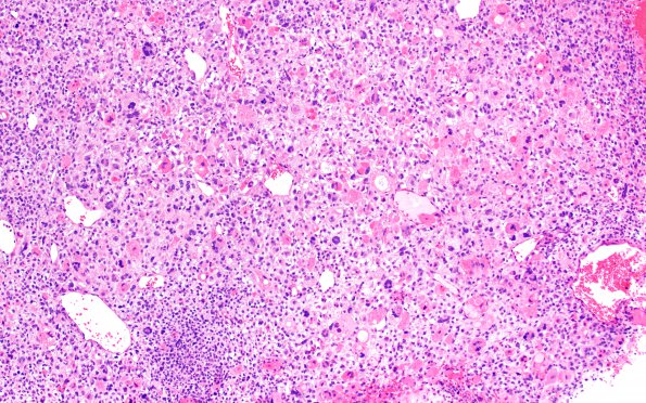 1B6 Primary Intracranial Sarcoma, Dicer 1 Mutant (Case 1) H&E 10X 2