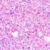 1B7 Primary Intracranial Sarcoma, Dicer 1 Mutant (Case 1) H&E 20X 2