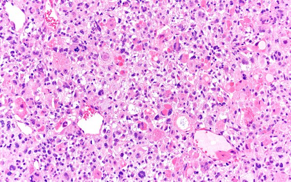 1B7 Primary Intracranial Sarcoma, Dicer 1 Mutant (Case 1) H&E 20X 2