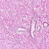 1C1 Primary Intracranial Sarcoma, Dicer 1 Mutant (Case 1) Retic 20X