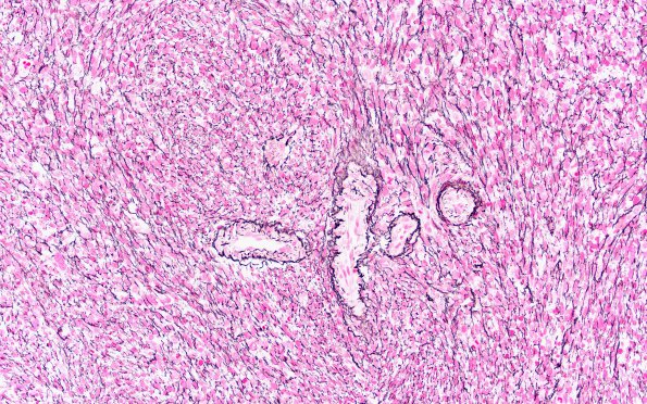 1C1 Primary Intracranial Sarcoma, Dicer 1 Mutant (Case 1) Retic 20X