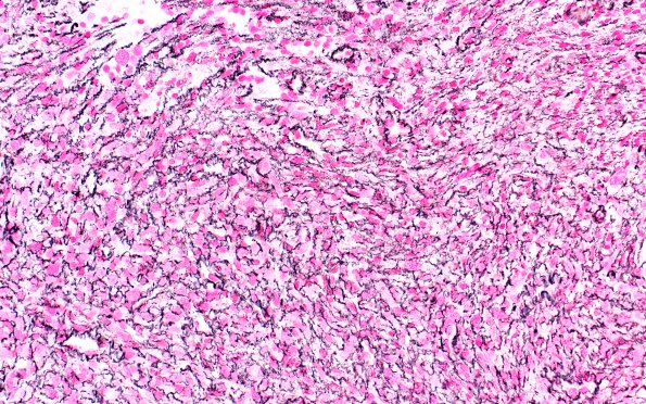 1C2 Primary Intracranial Sarcoma, Dicer 1 Mutant (Case 1) Retic 40X 2