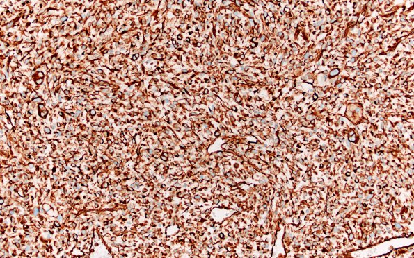 1D Primary Intracranial Sarcoma, Dicer 1 Mutant (Case 1) VIM 20X