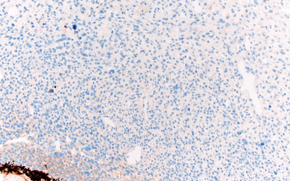 1E1 Primary Intracranial Sarcoma, Dicer 1 Mutant (Case 1) GFAP 20X