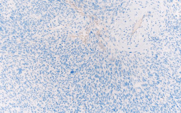 1E2 Primary Intracranial Sarcoma, Dicer 1 Mutant (Case 1) Olig2 20X