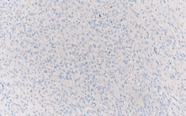 1E3 Primary Intracranial Sarcoma, Dicer 1 Mutant (Case 1) S100 20X