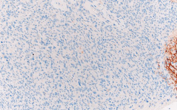 1E4 Primary Intracranial Sarcoma, Dicer 1 Mutant (Case 1) SYN 20X