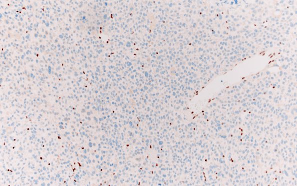 1F1 Primary Intracranial Sarcoma, Dicer 1 Mutant (Case 1) ATRX 20X