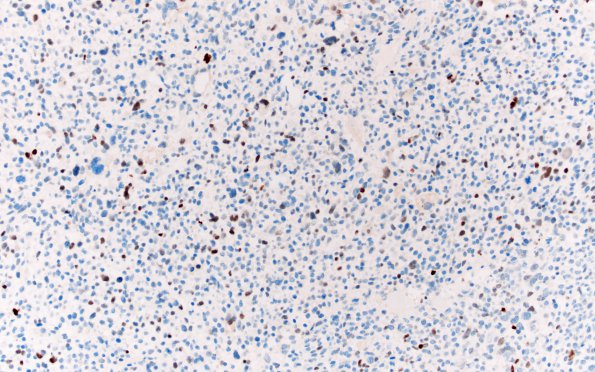 1F2 Primary Intracranial Sarcoma, Dicer 1 Mutant (Case 1) p53 20X