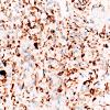 1G2 Primary Intracranial Sarcoma, Dicer 1 Mutant (Case 1) Desmin 40X 2