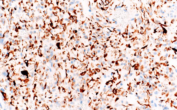 1G2 Primary Intracranial Sarcoma, Dicer 1 Mutant (Case 1) Desmin 40X 2