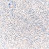 1G3 Primary Intracranial Sarcoma, Dicer 1 Mutant (Case 1) Myogenin 20X