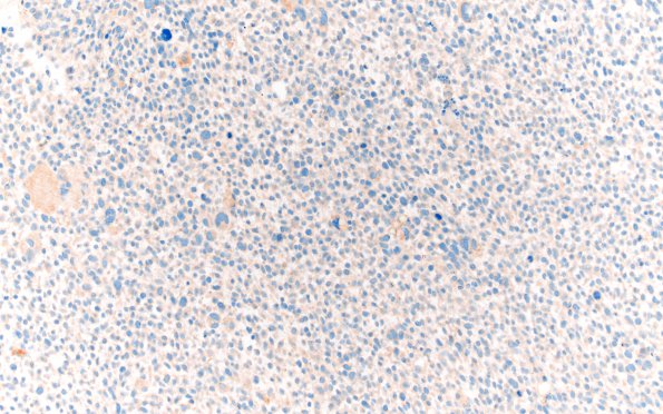 1G3 Primary Intracranial Sarcoma, Dicer 1 Mutant (Case 1) Myogenin 20X