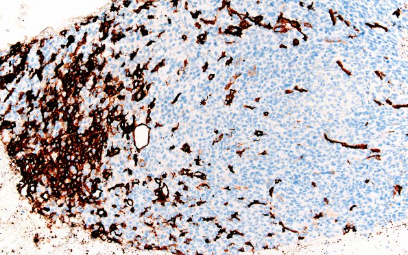 1H Primary Intracranial Sarcoma, Dicer 1 Mutant (Case 1) CD34 20X