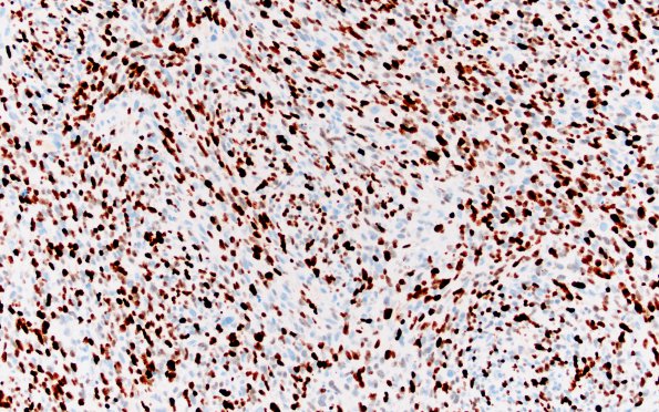 1I Primary Intracranial Sarcoma, Dicer 1 Mutant (Case 1) Ki67 20X