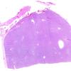 10B1 Hemangiopericytoma (Case 10) H&E WM