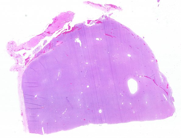 10B1 Hemangiopericytoma (Case 10) H&E WM