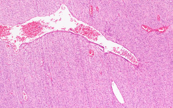 10B2 Hemangiopericytoma (Case 10) H&E 10X