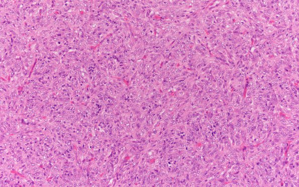 10B3 Hemangiopericytoma (Case 10) H&E 20X