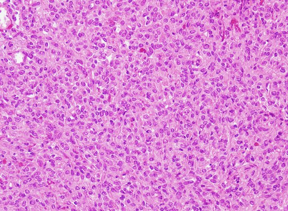 11 Hemangiopericytoma (Multiple cases) H&E 1