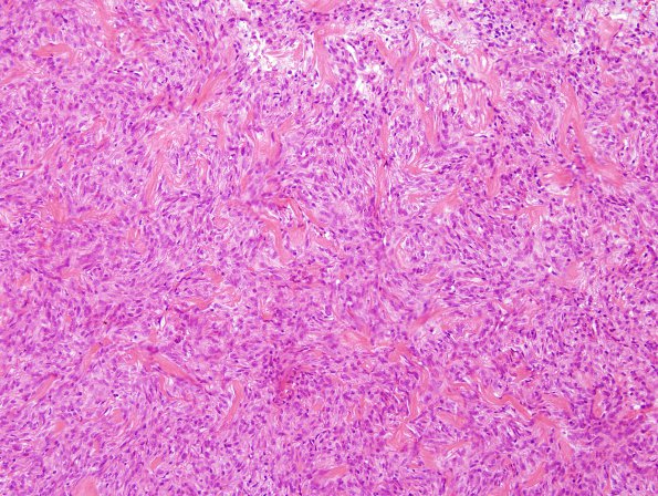 11 Hemangiopericytoma (Multiple cases) H&E 3 (2)