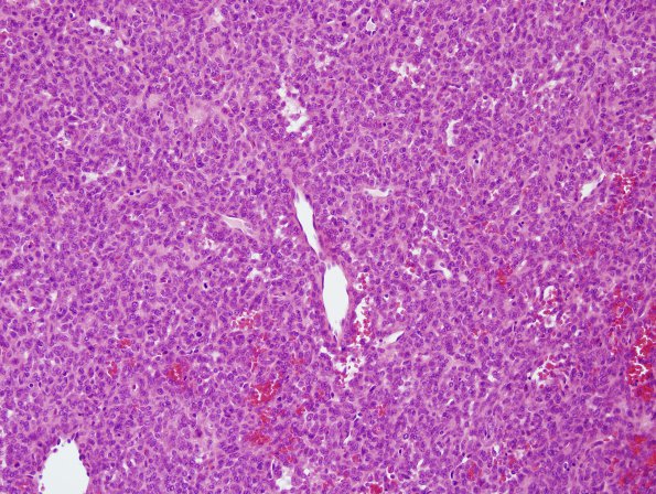 11 Hemangiopericytoma (Multiple cases) H&E 3