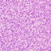 11 Hemangiopericytoma (Multiple cases) H&E 4