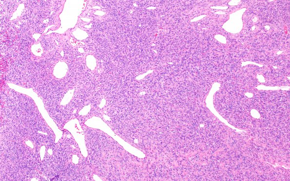 11 Hemangiopericytoma WHO III (Multiple cases) H&E 4