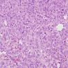 11 Hemangiopericytoma, anaplastic (Multiple cases) H&E 2