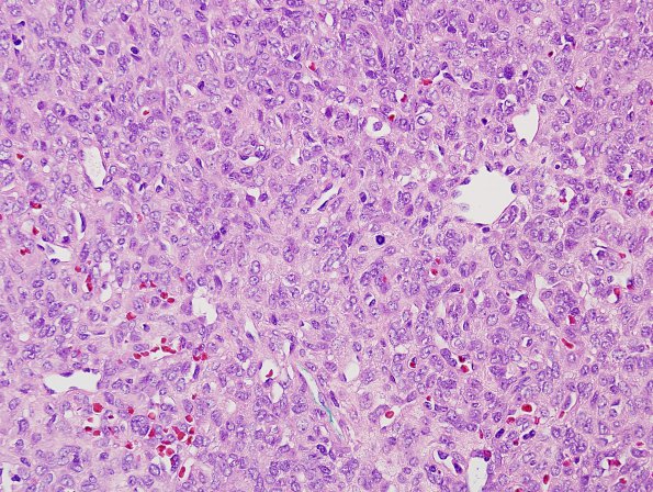 11 Hemangiopericytoma, anaplastic (Multiple cases) H&E 2