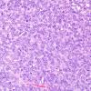 11A1 Hemangiopericytoma (Multiple cases) H&E 3