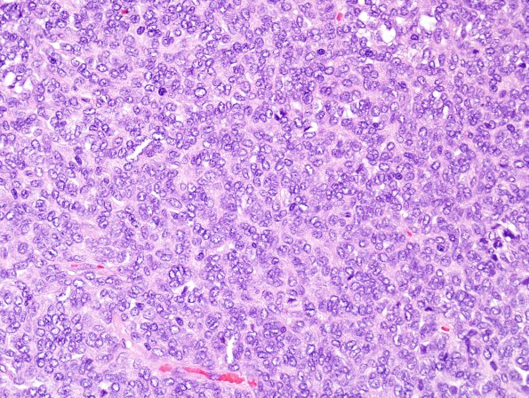 11A1 Hemangiopericytoma (Multiple cases) H&E 3