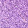 11A2 Hemangiopericytoma (Multiple cases) H&E 1