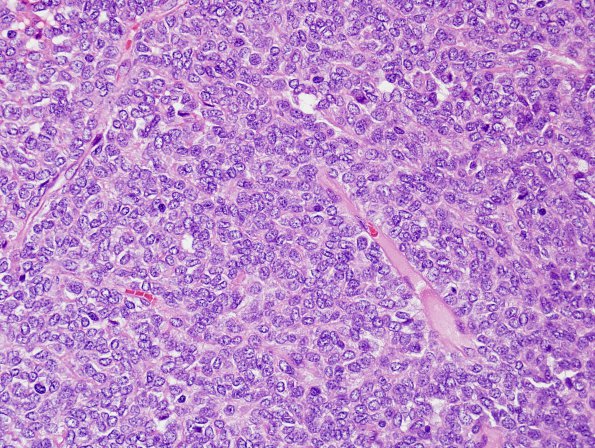 11A2 Hemangiopericytoma (Multiple cases) H&E 1