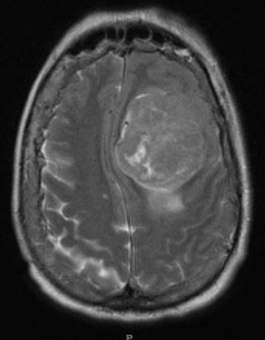 12A Hemangiopericytoma, Grade III (Case 12) T2 - Copy