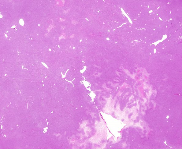 12C1 Hemangiopericytoma, Grade III (Case 12) H&E whole mount