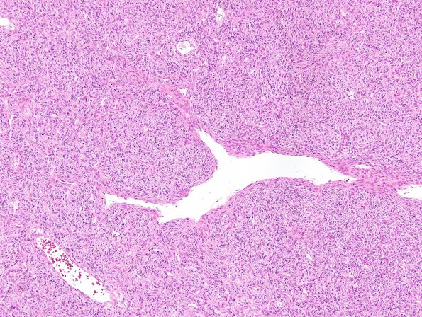 12C2 Hemangiopericytoma, Grade III (Case 12) H&E 11