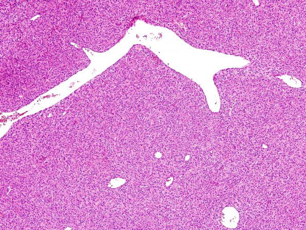 12C3 Hemangiopericytoma, Grade III (Case 12) H&E 7