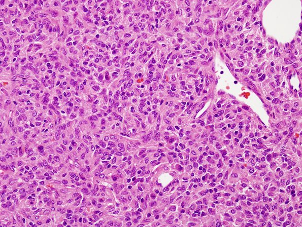 12C4 Hemangiopericytoma, Grade III (Case 12) H&E 4