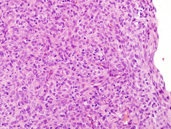 12C5 Hemangiopericytoma, Grade III (Case 12) H&E 1