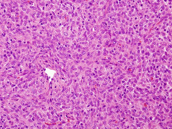 12C6 Hemangiopericytoma, Grade III (Case 12) H&E 3