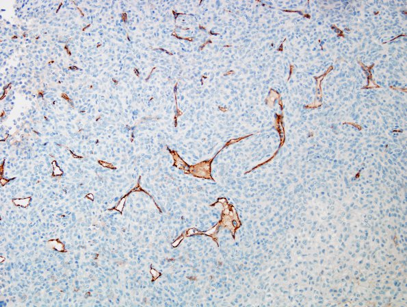 12D Hemangiopericytoma, Grade III (Case 12) CD34 1