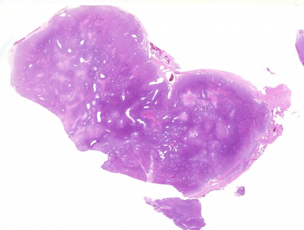 13A1 Hemangiopericytoma (Case 13) 1 H&E whole mount