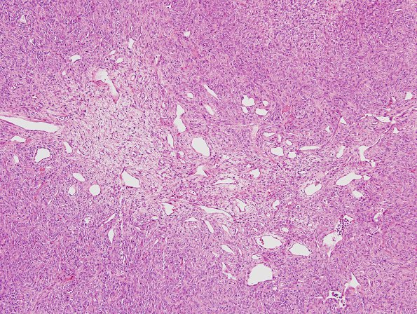 13A3 Hemangiopericytoma (Case 13) H&E 8