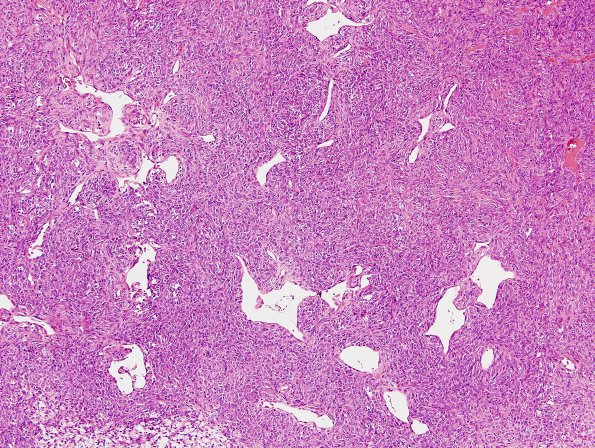 13A4 Hemangiopericytoma (Case 13) H&E 2 (2)