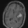 14A1 Hemangiopericytoma, anaplastic (Case 14) T1 2 - Copy