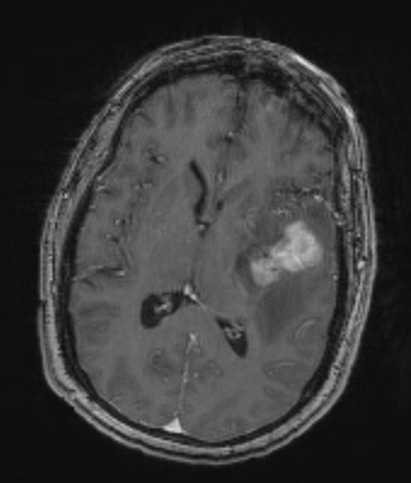 14A1 Hemangiopericytoma, anaplastic (Case 14) T1 2 - Copy