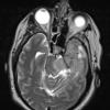 14A2 Hemangiopericytoma, anaplastic (Case 14) T2 3 - Copy